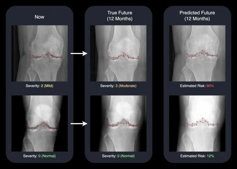 AI Brings Tomorrow’s X-Rays to Life, Helping Doctors Fight Arthritis Sooner AI Brings Tomorrow’s X-Rays to Life, Helping Doctors Fight Arthritis Sooner